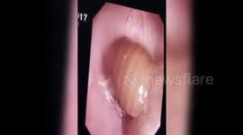 Doctor removes live leech from man's throat