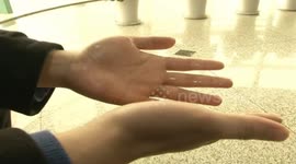 Man trying to find a girlfriend goes to treat palmar hyperhidrosis before Valentine's Day