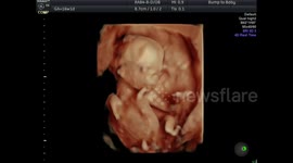 Tiny 16 week baby waving at Mum and Dad during its ultrasound scan