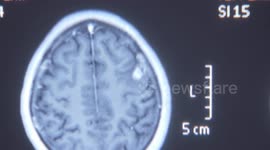Doctor removes huge live parasite from woman's head