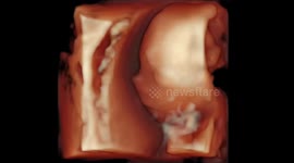 Unborn baby smiles at camera at 4d echography