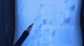 Doctors remove six-centimetre-long needle from toddler's stomach