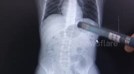 Chinese couple swallow 20-centimetre knitting needles after argument