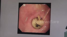 Doctor removes mushrooms 'growing' in woman's stomach