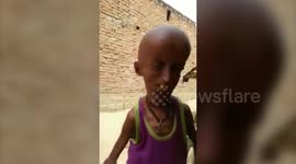 A 21-year-old man in India who has the body of a 160 YEAR-OLD