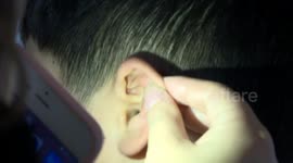 Doctor removes germinated plant seed stuck in boy's ear