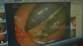 Man swallows two pens after 'argument with wife'