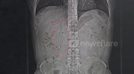Doctor removes ball pens stuck in man's stomach for 36 years