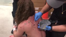 GRAPHIC WARNING HARDCORE Pro Wrestler Joey Janela has several thumbtacks removed from his flesh after a hadcore battle.
