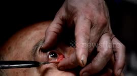 Chinese ancient art of washing eyes with knife