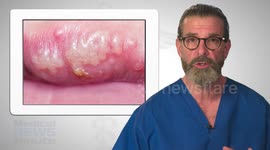 Herpes and Cold Sores