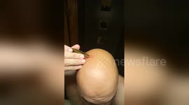 Newsflare Edit - Home Cyst Surgery