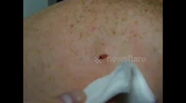 Pus Cyst on Back Popped Squeezed Exploded - Edit