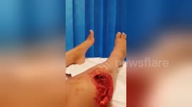 Newsflare Edit - my friend had a falll