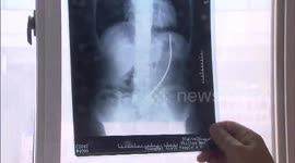 Doctor removes steel wire from man's stomach