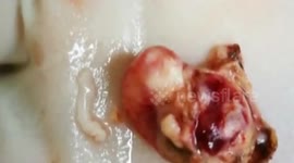 Doctor removes live parasite from teenager's head