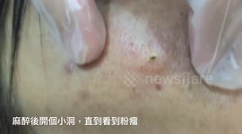 Big Cyst Extraction On Face, Pus coming out like stringy cheese