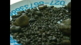 Chinese elderly woman has hundreds of gallstones removed from her body