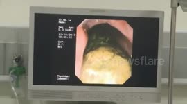 Doctor removes huge gastric bezoars in man's stomach
