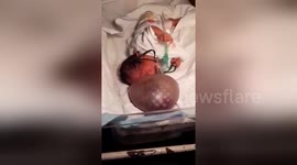 Newsflare Edit - Newborn baby girl with giant red bubble on her face baffling doctors