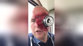 Gravesend man struggles to remove Halloween costume from his face