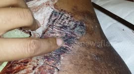 **Graphic Scabbing Skin Grafts*** 11/9/17
