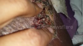**Graphic Reveal Of In Hospital Skin Graft Scabs*** 11/8/2017