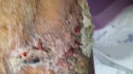 Skin Grafts, drying up and healing!