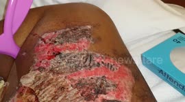 **skin grafts: last of the scabs 11/11/17**