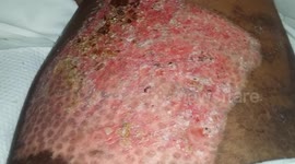 **Healing Up Skin Graft Donor Site 11/15/17*