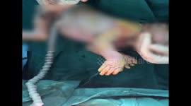 Chinese woman gives birth to baby twisting umbilical cord for 61 circus