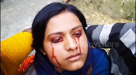 Exclusive;  Indian woman's rare condition causes her to 'sweat' blood from her eyes