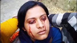 Exclusive: Indian woman's rare condition causes her to 'sweat' blood from her eyes