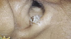 Living spider removed from ear of woman