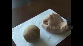 Doctor removes giant gall stone from man's body