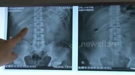 男子酒后误吞16厘米铁钎,“潜伏”腹中三个月才被发现