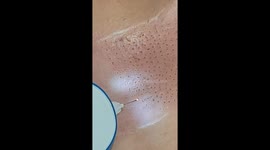 Up close iLift procedure