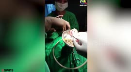 Surgeons removed a staggering 2,350 gallstones from a woman in one go
