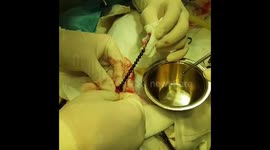 Surgeon pulls 38 magnetic balls from five-year-old boy's stomach