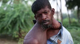 Indian man lives with 18kg tumour that has cost him his speech