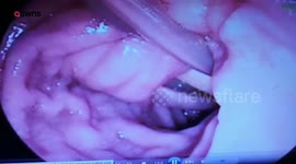 Live roundworms being removed from woman's bile duct