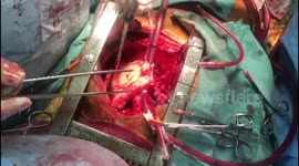 Newsflare Edit - Two children receive heart transplants from adults in India