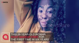 Vitiligo sufferer goes make up free for the first time in six years