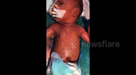 Colodian Baby If Cry his Skin will Crack Born In India
