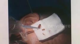 Doctor pulls live cockroach from man's ear