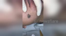 Dermatologist removes massive blackhead from patient's face