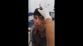 The doctor took a live leech from the man's nose