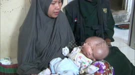 Baby born in Indonesia with two faces in desperate need of surgery