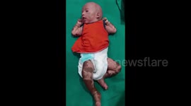 Plastic boy born 1&half month before with a rare condition that gives his skin a waxy and shiny appearance is on verge of getting Cured in India with the help of Boston Children hospital