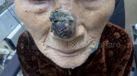 Woman lives with massive tumour on nose